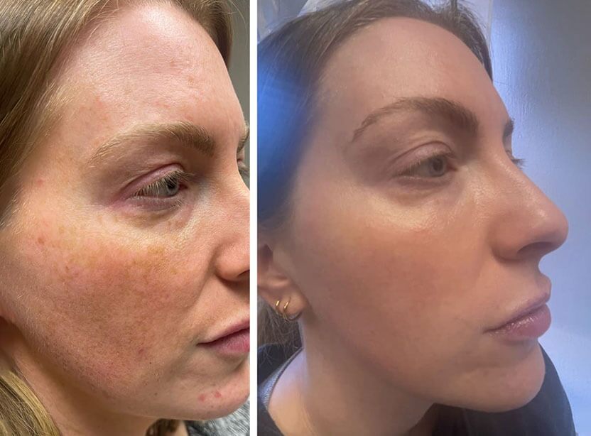Lumecca IPL