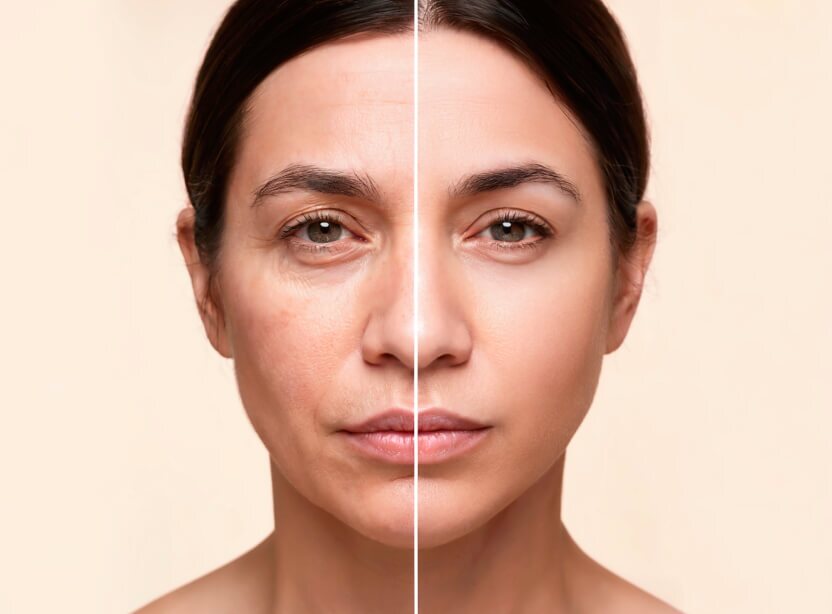 Sculptra